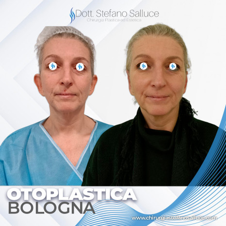 Otoplastica  Dott. Stefano Salluce